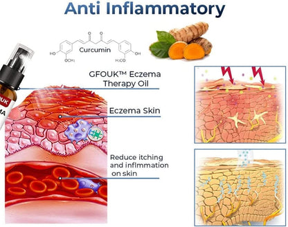 Sotuh Moon Psoriasis Relief Spray ( BUY 1 GET 1 FREE )