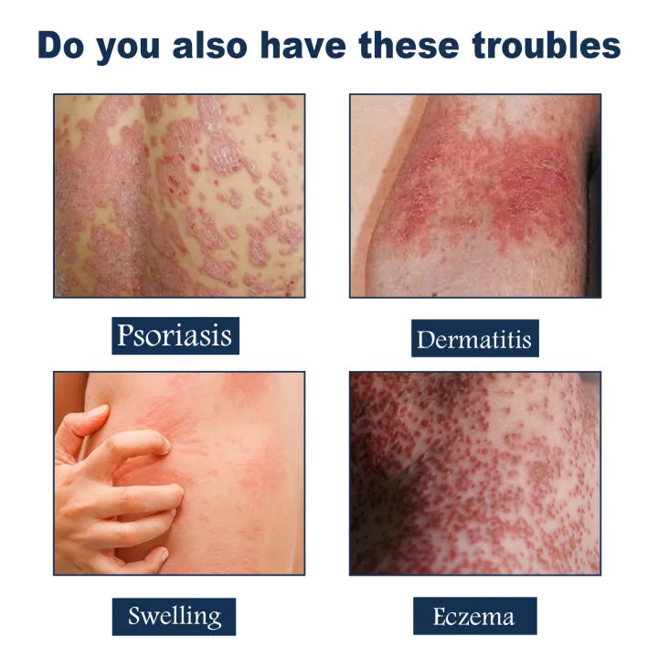 Sotuh Moon Psoriasis Relief Spray ( BUY 1 GET 1 FREE )