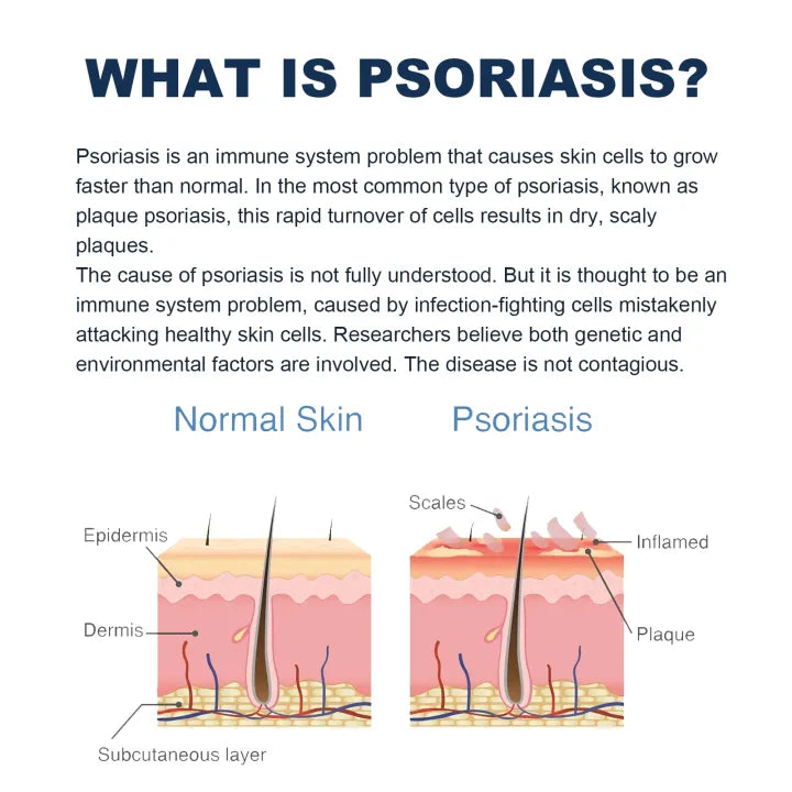 Sotuh Moon Psoriasis Relief Spray ( BUY 1 GET 1 FREE )