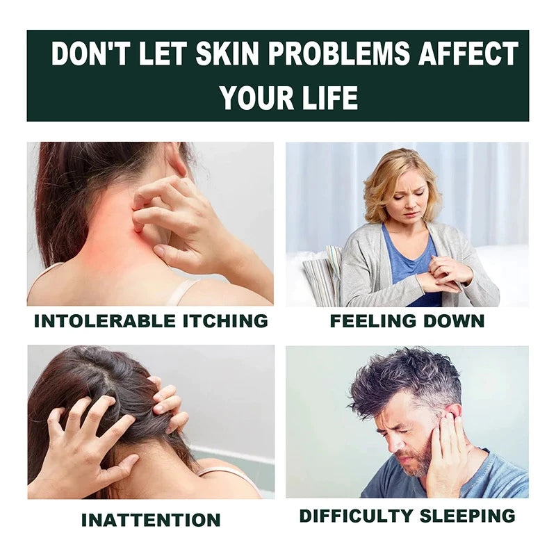 Japan Anti - Fungal Ointment Eczema Cream ( BUY 1 GET 1 FREE )