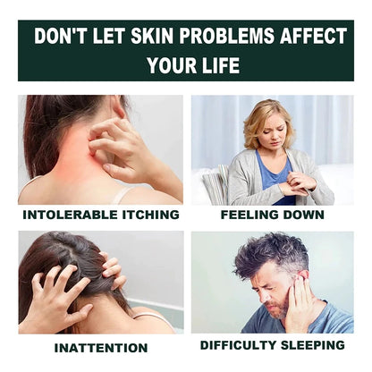 Japan Anti - Fungal Ointment Eczema Cream ( BUY 1 GET 1 FREE )