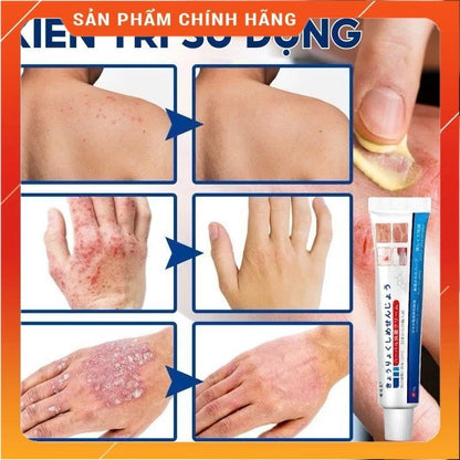 Japan Anti - Fungal Ointment Eczema Cream ( BUY 1 GET 1 FREE )